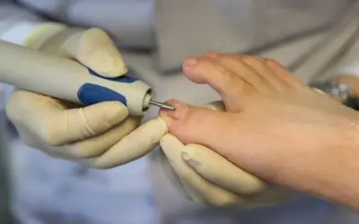 Common Causes of Toenail Fungus (and What To Do About It)