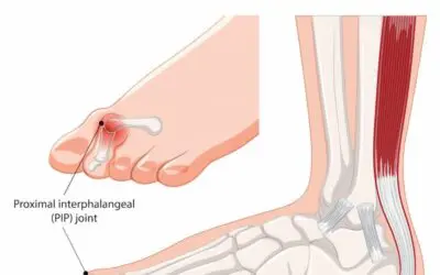 Is Hammer Toe Different From Mallet Toe?
