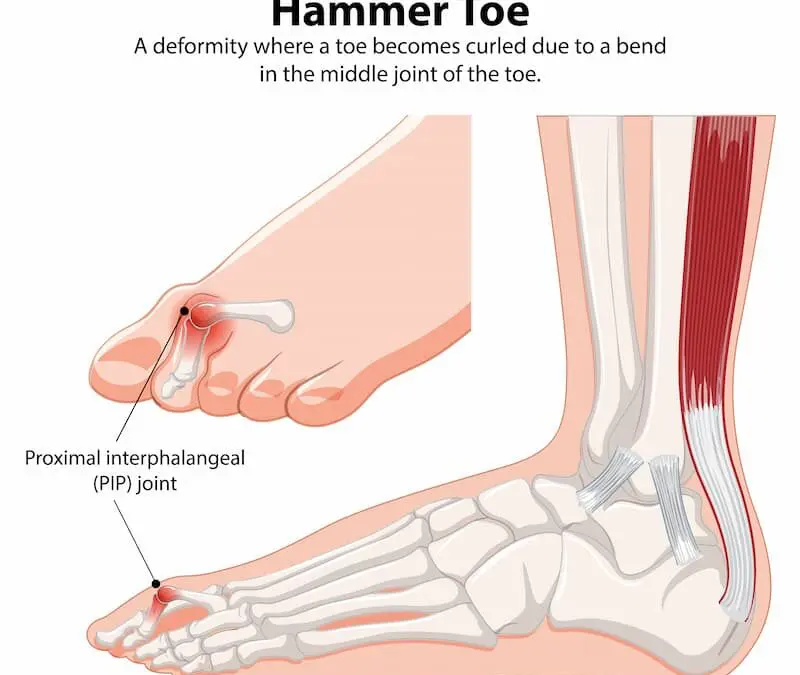 Is Hammer Toe Different From Mallet Toe?