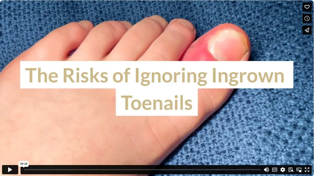 The Risks of Ignoring Ingrown Toenails