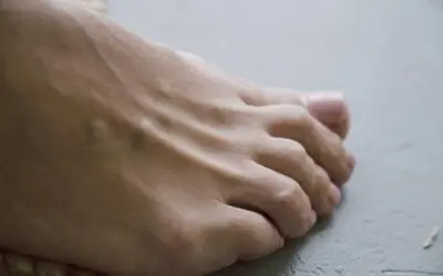 7 Essential Aftercare Tips for Ingrown Toenail Removal