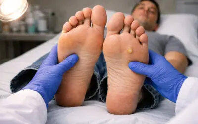 Clearing Up Common Questions About Warts