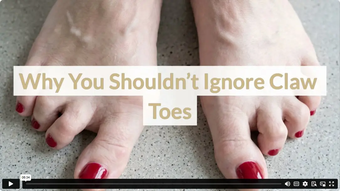 Why You Shouldn’t Ignore Claw Toes