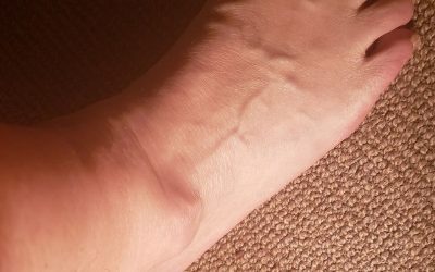 What to Expect With a Ganglion Cyst